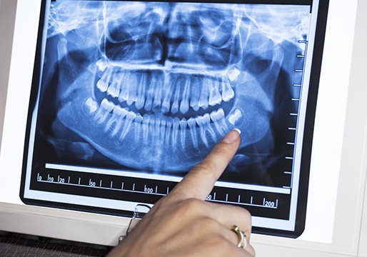 Panoramic smile x-rays on computer screen