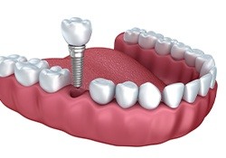 Animation of implant supported dental crown placement