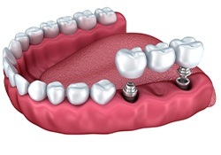 Animation of implant supported fixed bridge placement