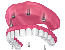 Animation of implant supported denture placement