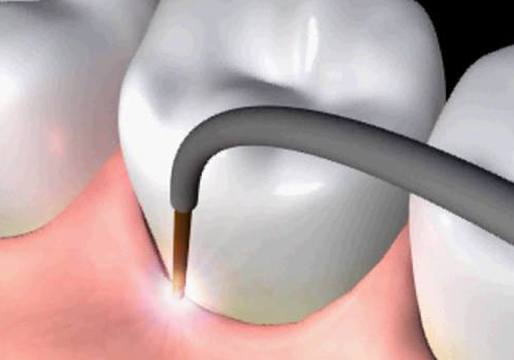 Animation of perioscopy process