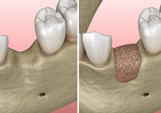 Animation of surgical site preservation treatment